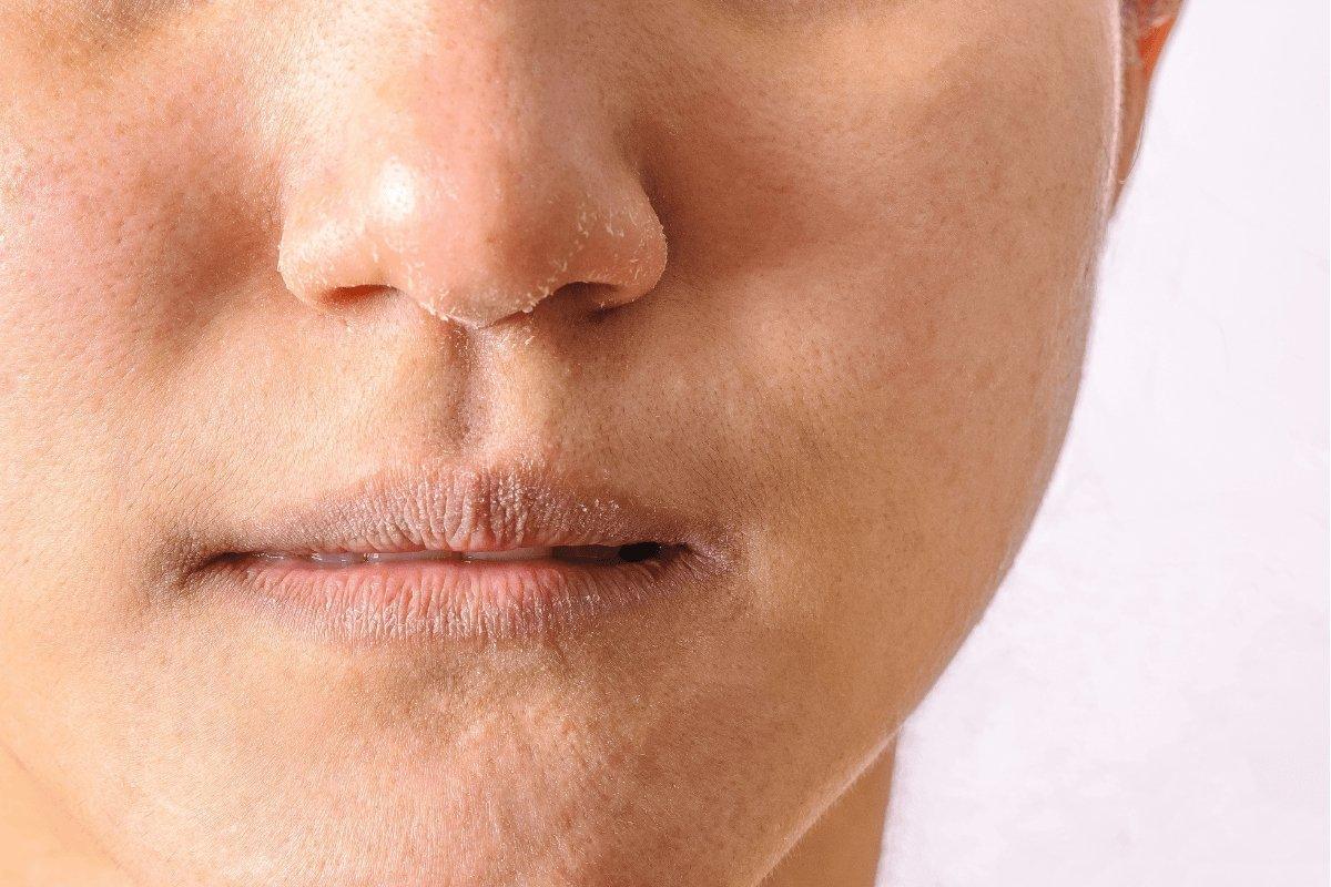 Dry Skin vs. Dehydrated Skin: How To Tell The Difference - Blue Haven Holistics