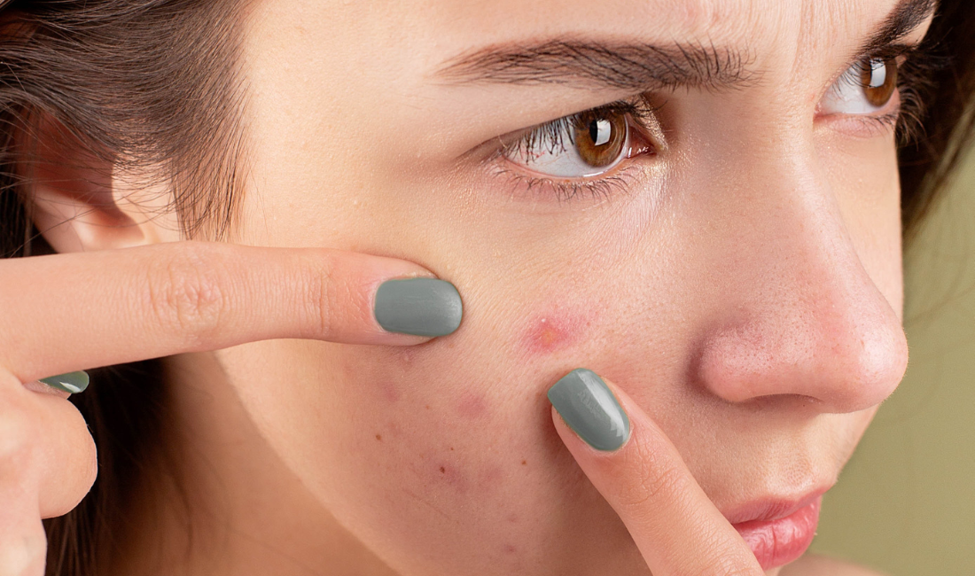 Skin Purging vs. Skin Breakouts - Blue Haven Holistics