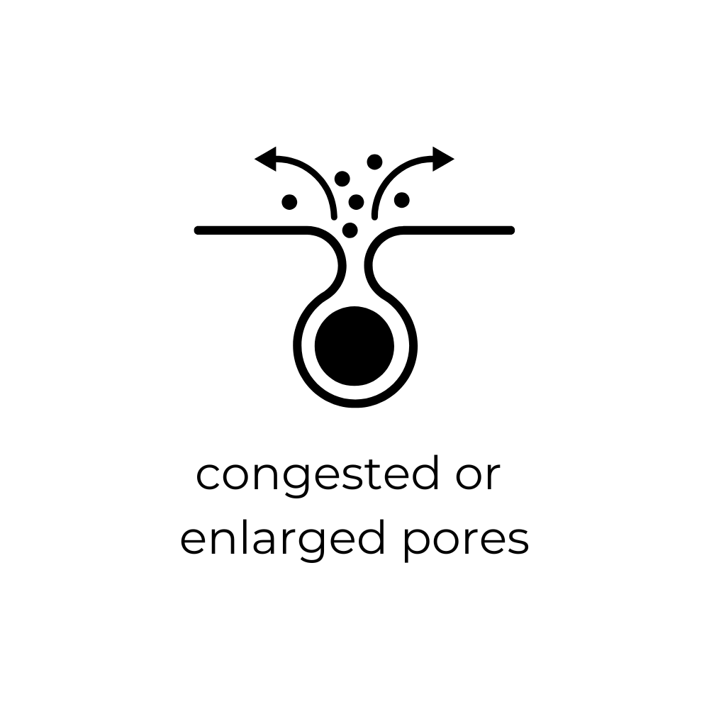 Illustration with arrows and text 'congested or enlarged pores' on a white background